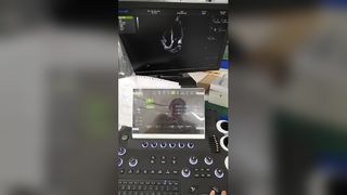 Sistema diagnostico a ultrasuoni color doppler con carrello BR-US01